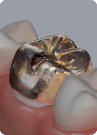 gold dental crown on molar