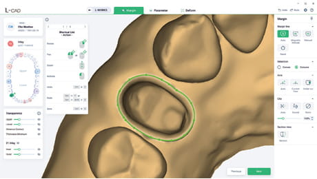 L-CAD interface margin stage featuring automatic margin line detection for dental prosthesis design.