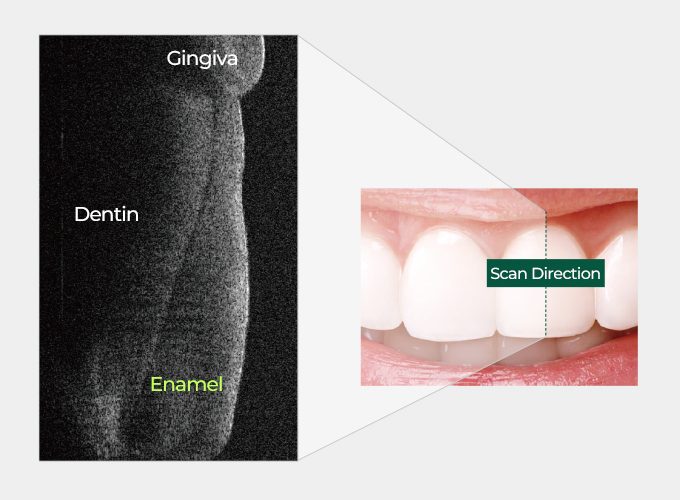 cross-sectional-image-of-a-tooth-by-octix