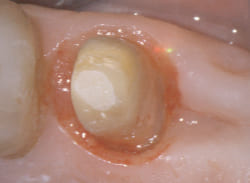 real-margin-point-contact-sub-gingival-prep